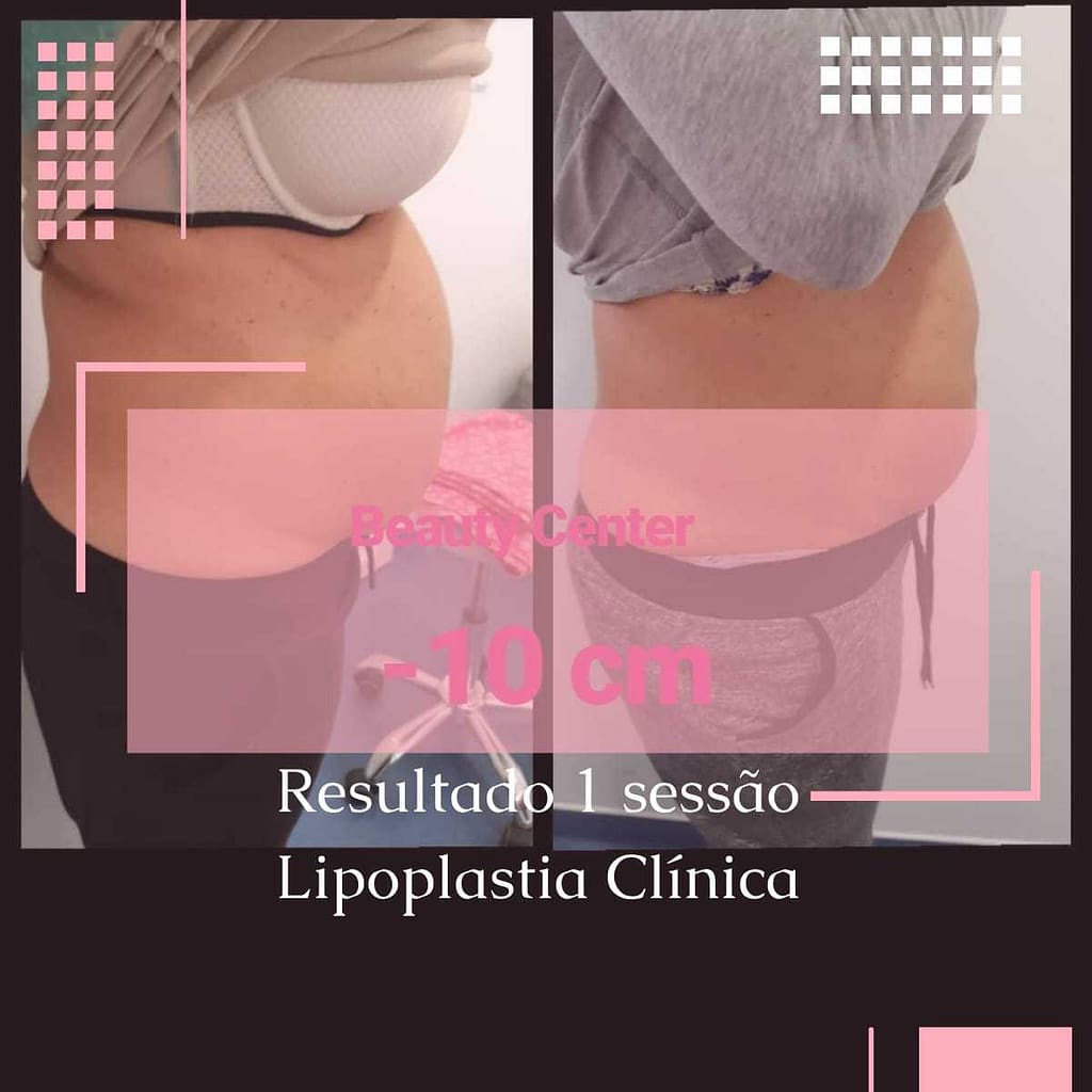 feedback lipoplastia beauty center saúde feedback lipoplastia beauty center saúde