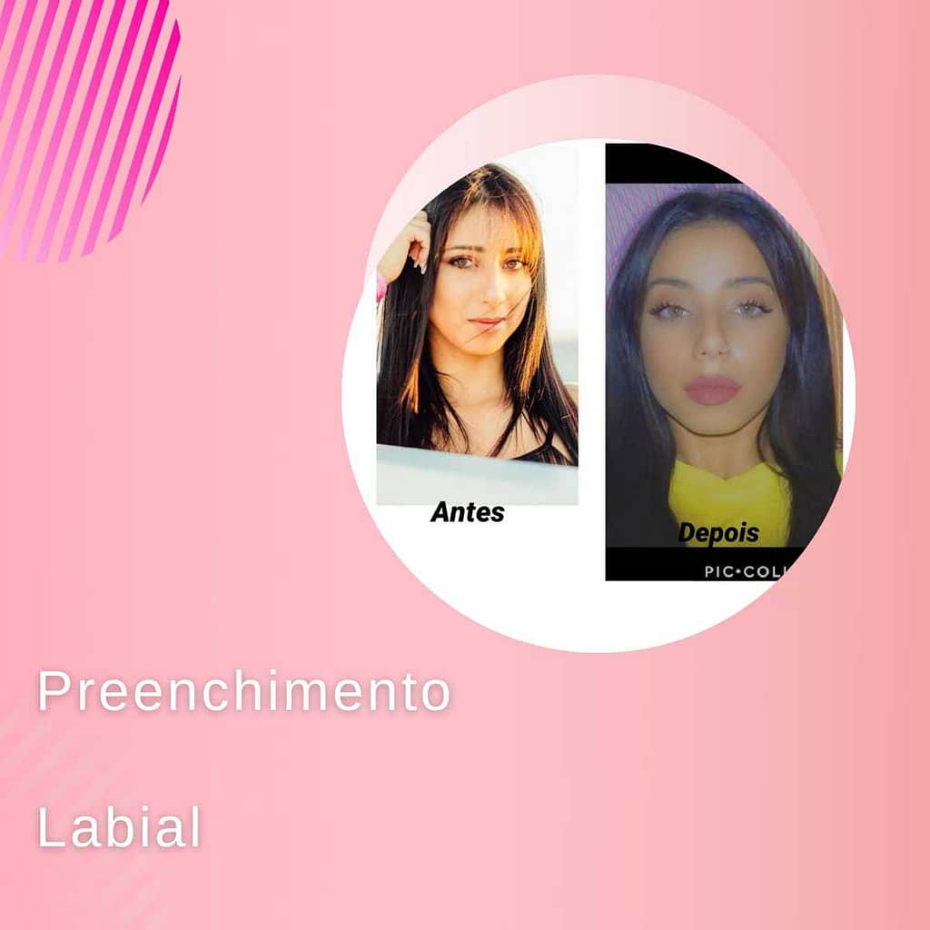 feedback preenchimento labial beauty center saúde feedback preenchimento labial beauty center saúde