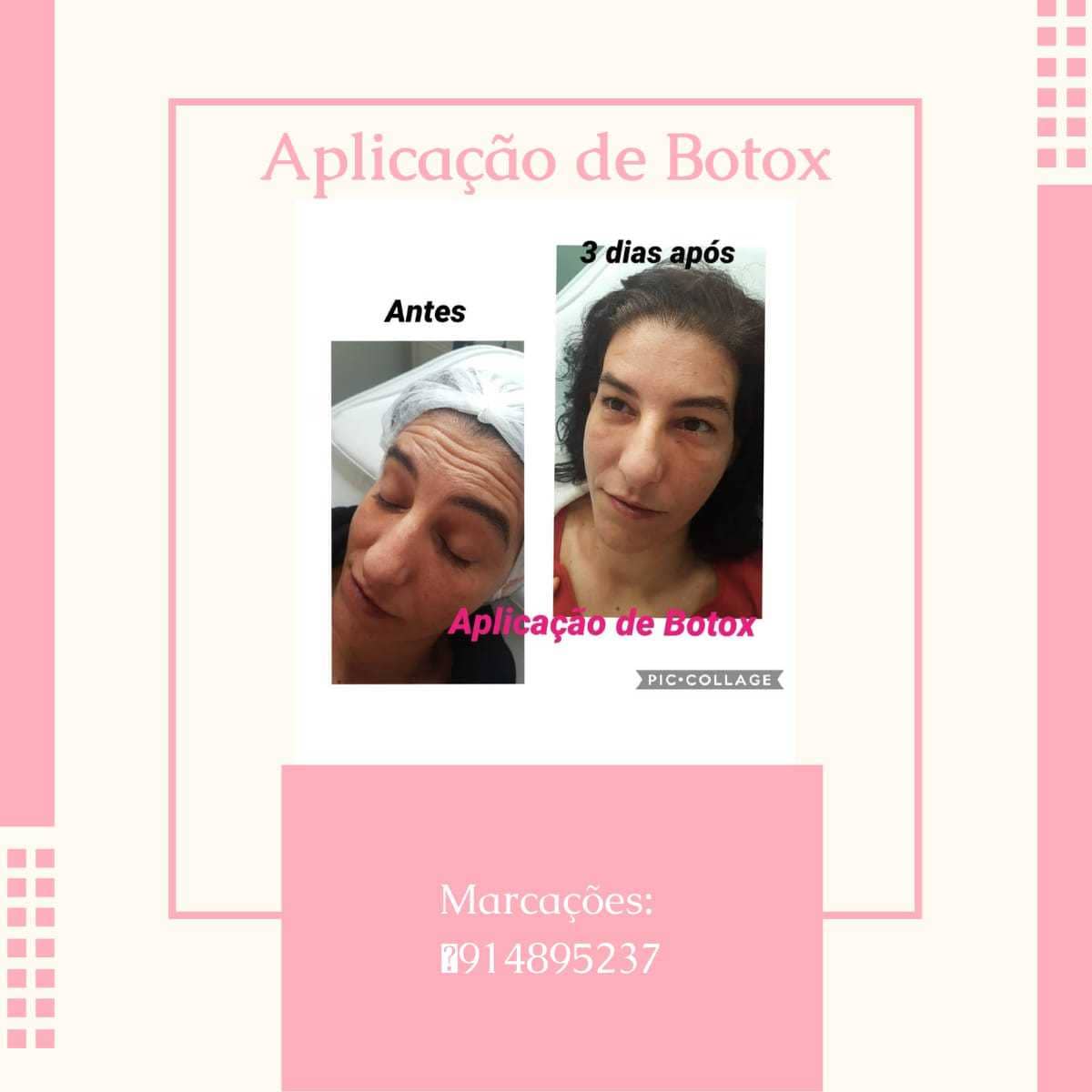 feedback aplicação de botox beauty center saúde