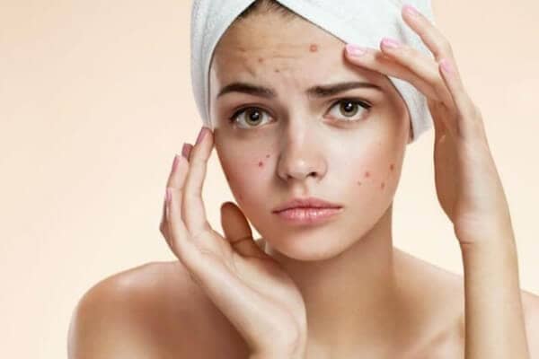 formacao acne no rosto beauty center saude